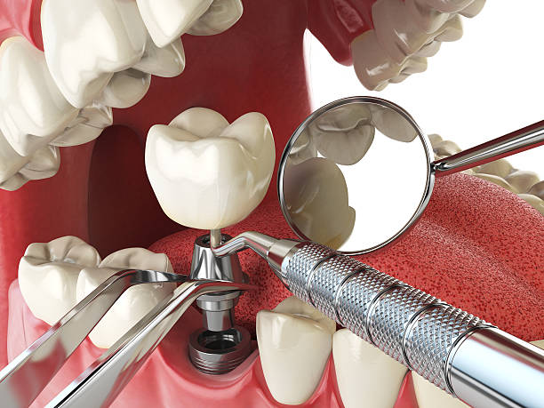 Best Dental Abscess Treatment in Indialantic, FL